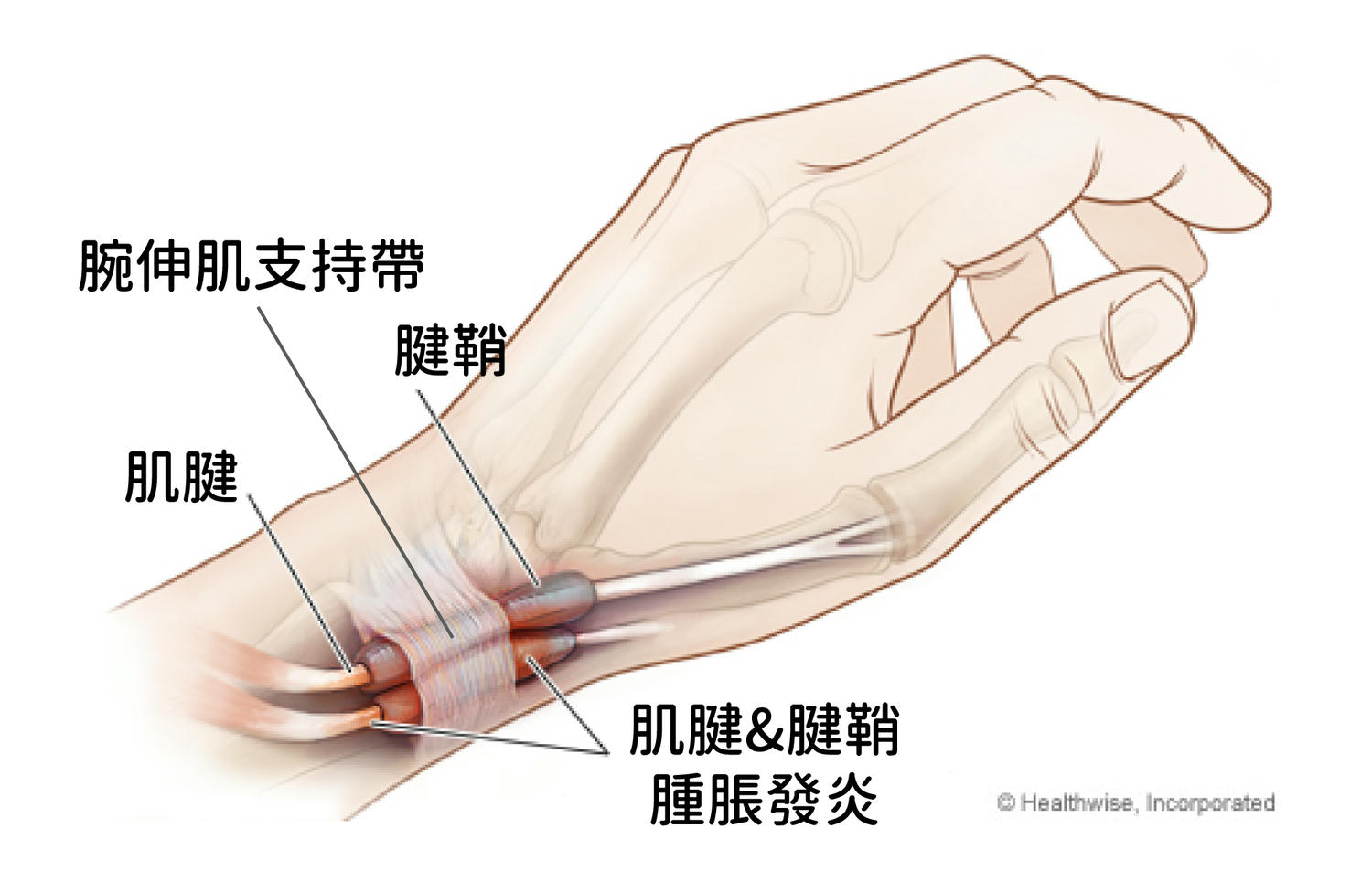 手腕肌腱發炎處